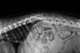 Vertebroplasti Nedir? Omurga Kırıklarında Modern Bir Tedavi