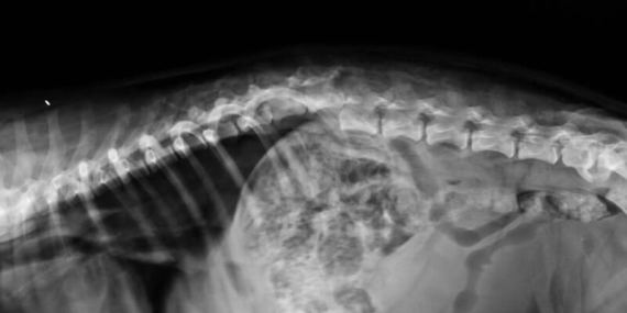 Vertebroplasti Nedir? Omurga Kırıklarında Modern Bir Tedavi
