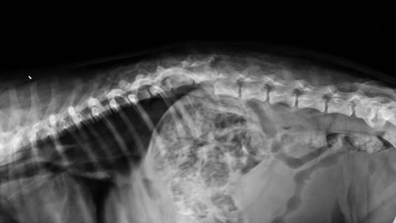 Vertebroplasti Nedir? Omurga Kırıklarında Modern Bir Tedavi